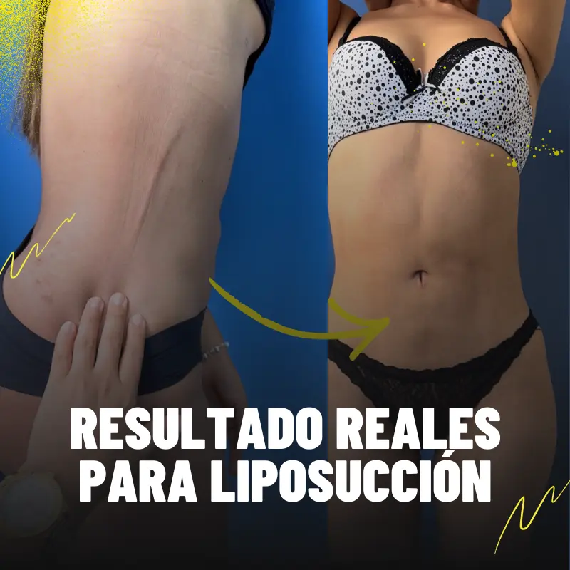 Drenaje post liposuccion en FISIO21