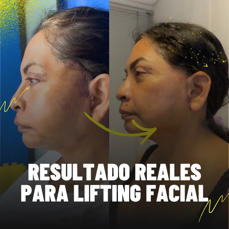 Resultados relaes lifting facial FISIO 21
