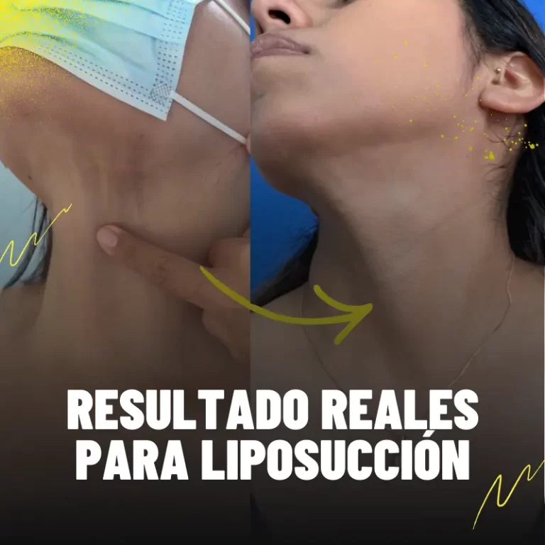Resultados reales lipopapada en FISIO21
