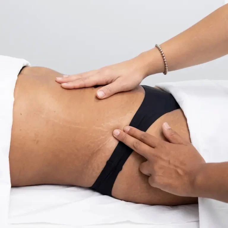 Mujer en sesión de drenaje post liposucción en Fisio21 Miraflores
